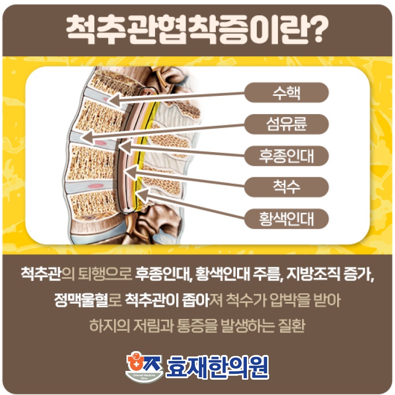 척추관협착증에 따른 허리 통증 관리 방법 알아보기