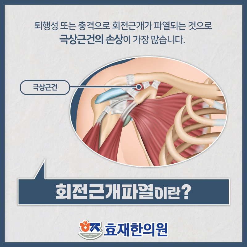 회전근개파열로 인한 어깨 통증, 살펴볼 관리 기준